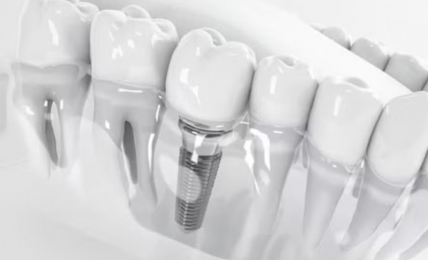 Implante zigomtico traz nova alternativa na implantodontia